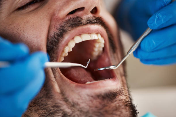 Best Emergency Treatment for Dental Infections or Abscesses in Princeton, WV